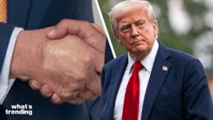 President Trump was diagnosed with chronic venous insufficiency, a common but manageable vein condition causing leg swelling, with doctors insisting he remains in “excellent health.”
